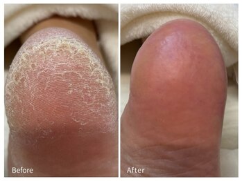 レフス 北参道店(REFUSS)/本格角質ケア