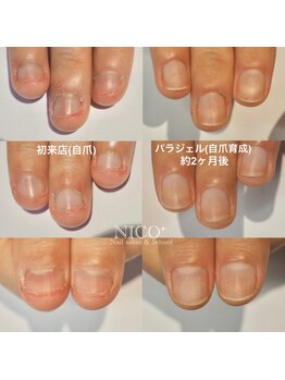 ニコプラス(NICO+)/自爪育成中