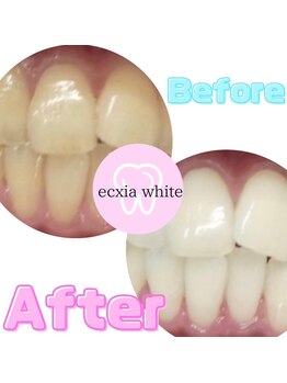 エクシアホワイトフジ(ecxia white fuji)/ホワイトニングビフォーアフター