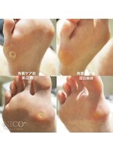 ニコプラス(NICO+)/足裏角質除去