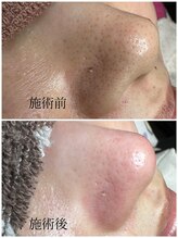 エクラ バイ シャンリィ(eclat by shanLy)/黒ずみとおさらば！！