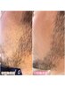 メンズお顔脱毛★最新の機器で美肌になりながら、しっかり綺麗に！