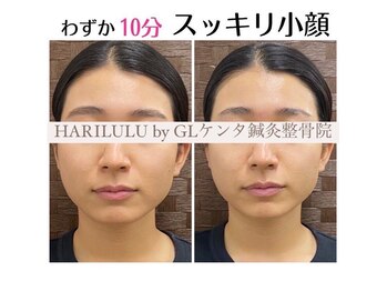 ハリルル 併設 GLケンタ鍼灸整骨院(HARILULU)/スッキリ小顔　ハイパーナイフ