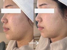 ロイ 初生店(LOI)/ダウンタイムなし！リフトアップ