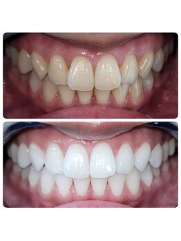 ホワイトニングセンター 広島福山駅前店/福山市・尾道市ホワイトニング