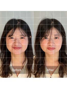 リュクス 恵比寿 代官山(LUXE)/施術(美容鍼) Before After