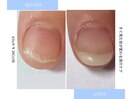 【深爪ケア】自爪風スカルプ
