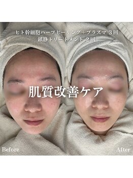 イロハ(IROHA)/肌質改善ケア