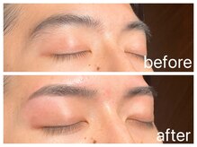 クラシックス(CLASSICS)/メンズワックス脱毛