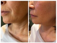 リンダ(Rinda)/レッドショット★口横たるみ改善