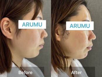 アルム コリア(ARUMU KOREA)/水光ピーリング