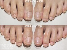ニコプラス(NICO+)/フット爪育ネイルケア