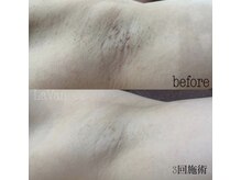 ラヴァン(LaVan)/ワキ脱毛（３回）