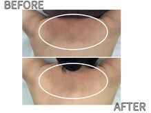 ライム 浦和(LIME)/背中ハーブピーリング