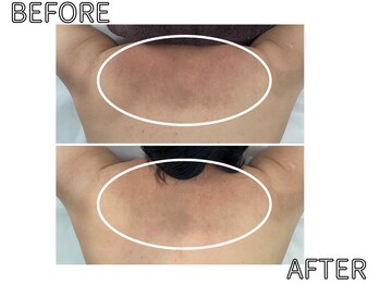 ライム 浦和(LIME)/背中ハーブピーリング