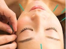 アイワ鍼灸整骨院/美容鍼