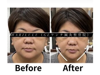 ハリルル 併設 GLケンタ鍼灸整骨院(HARILULU)/ヘッドHARI×ドライヘッドスパ