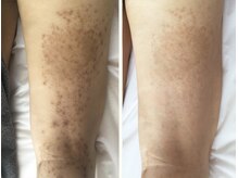 ノットノット 自由が丘(Not Knot)の雰囲気（グリーンピールボディ1day ＋ リンパストレッチ/虫刺され跡ケア）