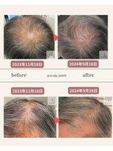 スカルプラボ 倉敷店(Scalp Lab)/moumitu症例10ヶ月