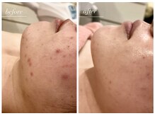 ラヴィン なんばスカイオ店(Lovin)/【ハードハーブピーリング 8回】