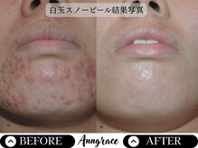 アングレイス(Anngrace)/【本気の肌質改善！】迷子脱却！