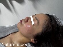 ナチュールムーン(Nature moon.)/ハーブピーリング　after
