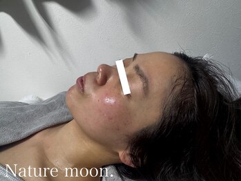 ナチュールムーン(Nature moon.)/ハーブピーリング　after