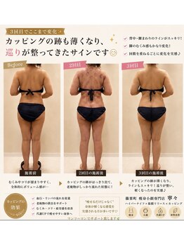 寧々/カッピング【ビフォアアフター】