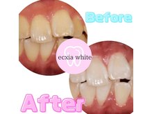エクシアホワイトフジ(ecxia white fuji)/ホワイトニングビフォーアフター