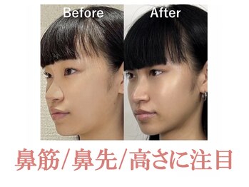 隆鼻矯正専門店 ラプリセレネ (Raplit Selene)/隆鼻+輪郭矯正(小顔)40分20回