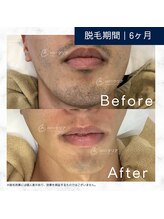 メンズクリア 武蔵小杉店/【メンズクリア】お客様の施術例