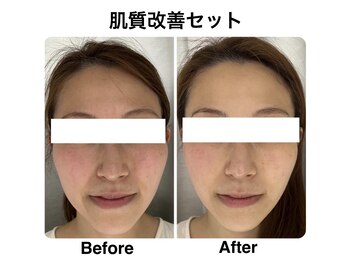 ネオファースト(NeoFirst)/肌質改善セット【30代女性】