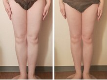 マナ(mana)/脚のむくみ２週間の変化