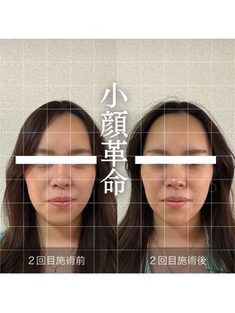 ザ リフト カドモリ 鹿児島 霧島(The Lift KADOMORI)/Before→After