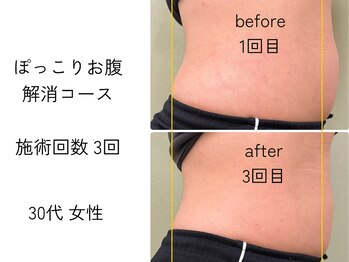 ほねつぎ一休さん 宇品店/ぽっこりお腹解消コース