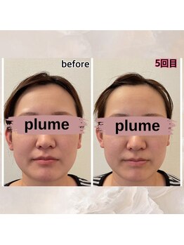 小顔になりたい