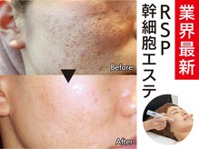 ソイズ 新保店(SOIS)の雰囲気（業界最新RSP幹細胞エステで、目の下～ほほの毛穴開きが改善）