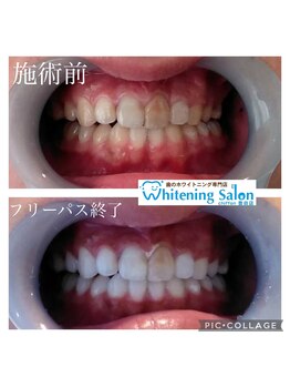 シフォン 豊田店/3週間通い放題フリーパスコース