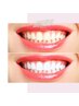 【男女OK】歯科ホワイトニングと同等効果◎より白い歯☆ス-パ-ホワイトニング