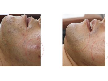 フ/施術効果比較写真