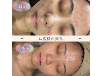 美肌研究所 絹 田辺店/月1お手入れでニキビケア♪