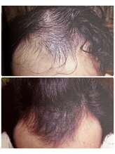 シンデレラ メンズ(Cinderella)/育毛促進コース