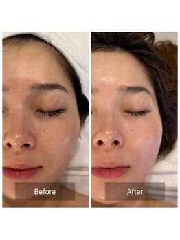 マインエム(mine.m)/vvsダイヤモンドピーリング