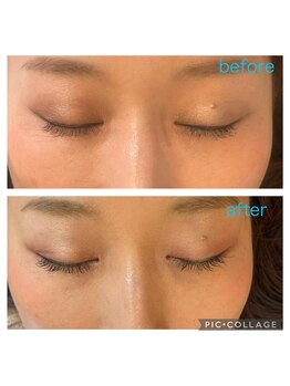 ひだまり鍼灸整骨院/before/after 目元のシワたるみ