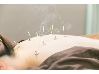 代官山アサ接骨院 鍼灸院(代官山 Asa 接骨院 鍼灸院)/体の冷えに鍼とお灸で体質ケア