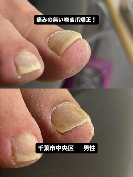 巻き爪じゅん 船橋店/巻き爪の痛みに悩む方へ