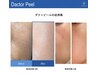 【5世代DactorPeel】韓国クリニックで大人気★ピーリング毛穴&あから顔 40分