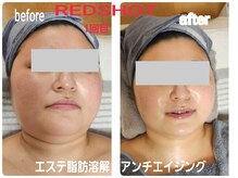 セレブリティ(Celebrity)の雰囲気（【最新美容★】脂肪分解REDショットで小顔たるみケア）