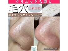 ウルレア(ulu lea)の雰囲気（【上新庄】上新庄発！毛穴エクストラクション　いちご鼻撃退）