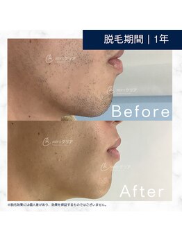メンズクリア 武蔵小杉店/【メンズクリア】お客様の施術例